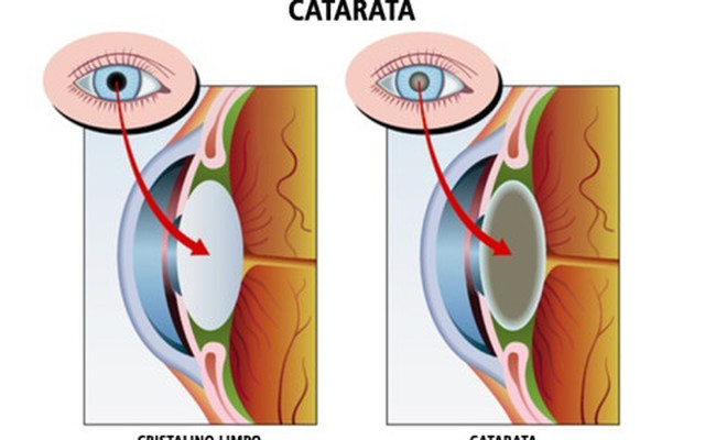  Cirurgia de Catarata com Facoemulsificação