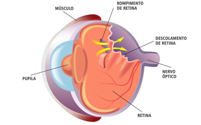 Cirurgia e Tratamento para Descolamento de Retina - COHR