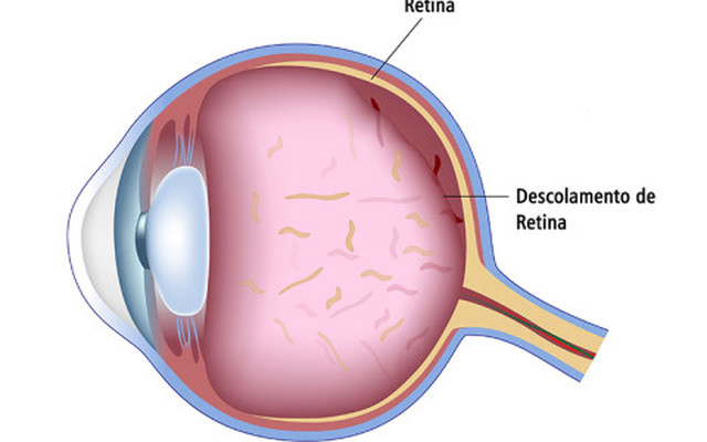 Cirurgia e Tratamento para Descolamento de Retina