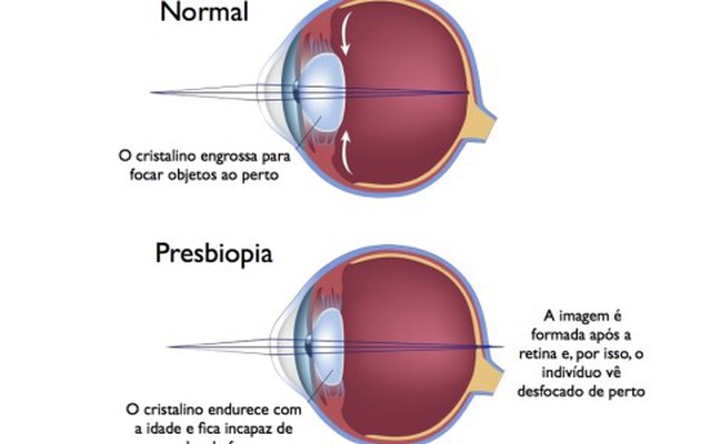 Presbiopia