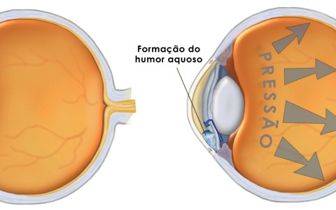 Glaucoma