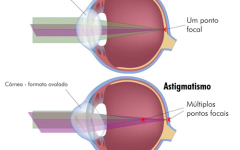 Astigmatismo