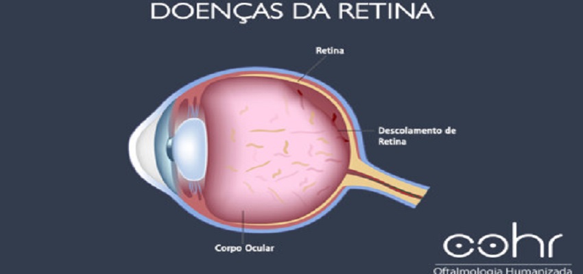 Cirurgia e Tratamento para Descolamento de Retina - COHR