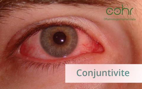 Conjuntivite