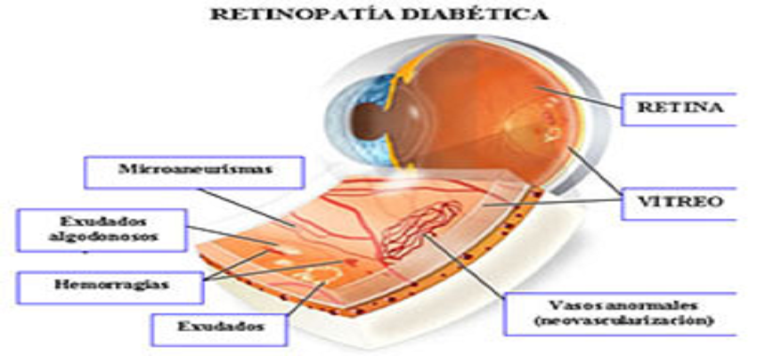 Cuidando dos Seus Olhos: Retinopatia Diabética