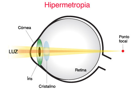 Hipermetropia