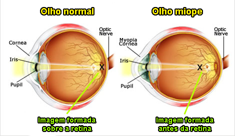 miopia este un plus minus picături pentru ochi medicamente pentru îmbunătățirea vederii