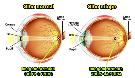 Calázio - COHR Oftalmologia Olímpia