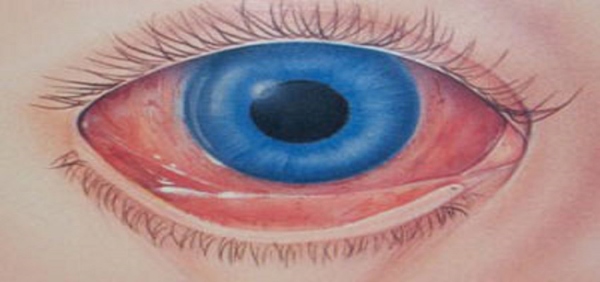 Cuidando dos seus olhos: Entenda a conjuntivite infecciosa