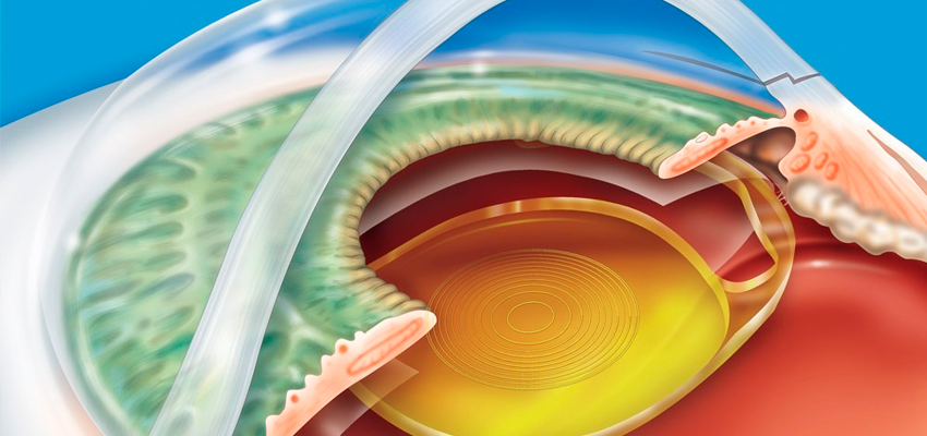 Catarata: facectomia com implante de lente intraocular