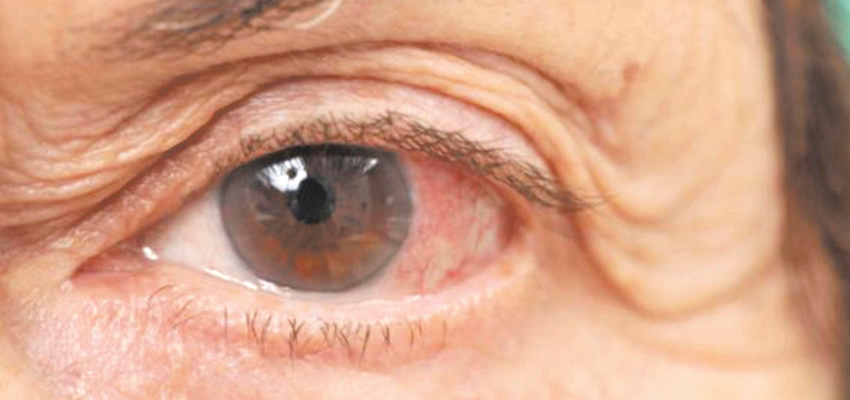 Cuidando dos Seus Olhos: Tratamento do Glaucoma pode Prevenir a Cegueira