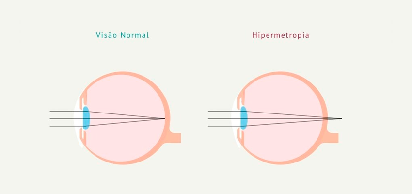 Hipermetropia 