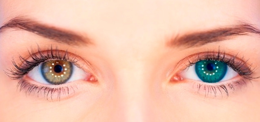 Heterocromia 