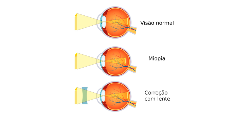 Miopia: sintomas e tratamento!