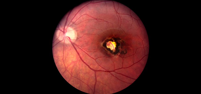 Considerações gerais sobre doenças da retina - Distúrbios