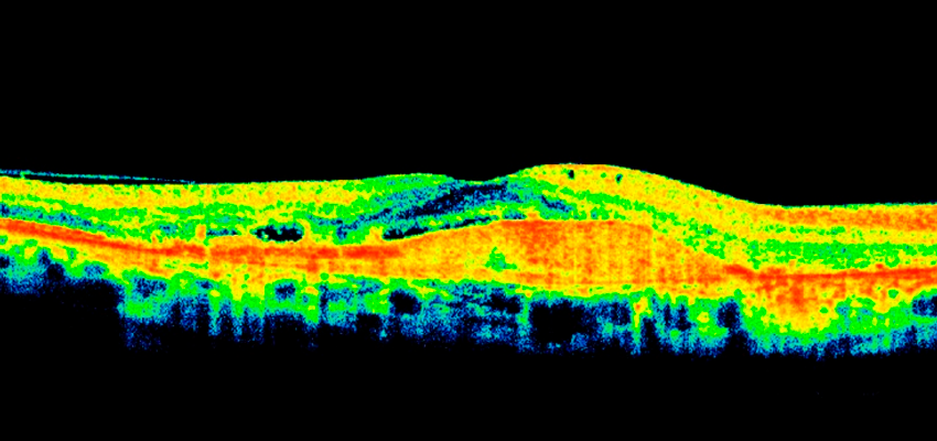 O que é descolamento da mácula com fluido sub-retiniano?